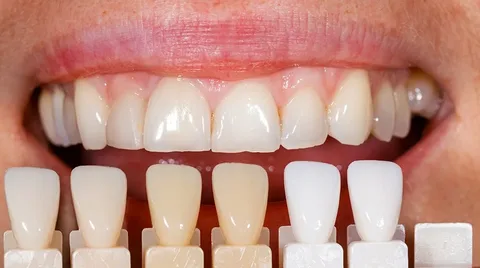 С какими проблемами на зубах помогут справиться виниры