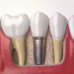 Зубные импланты цены в Одинцово