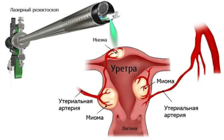 udalenie miomy matki laparoskopicheskim metodom sovremennyy podhod k lecheniyu